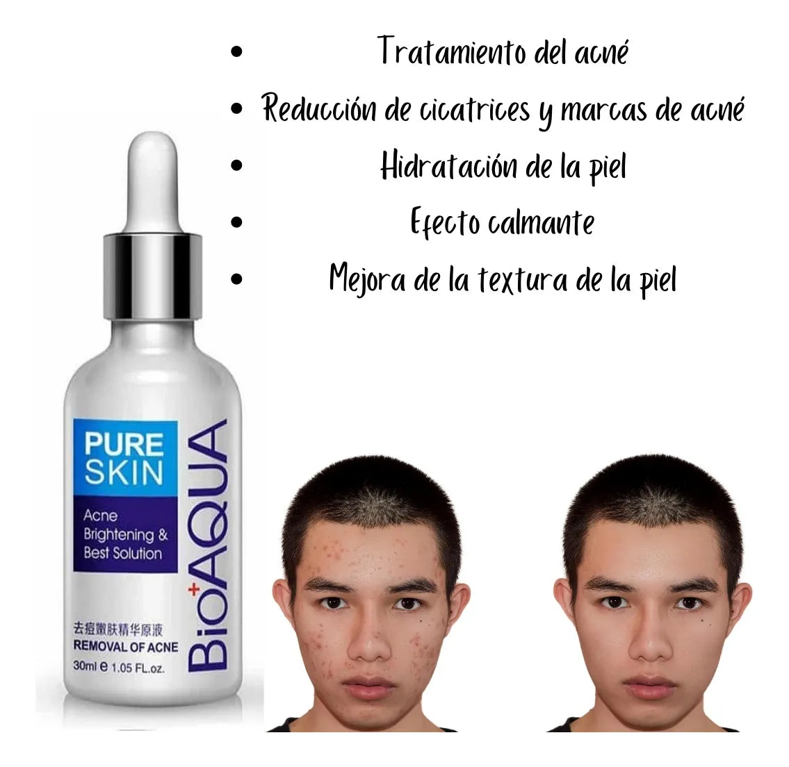 Serum Antiacne Bioaqua