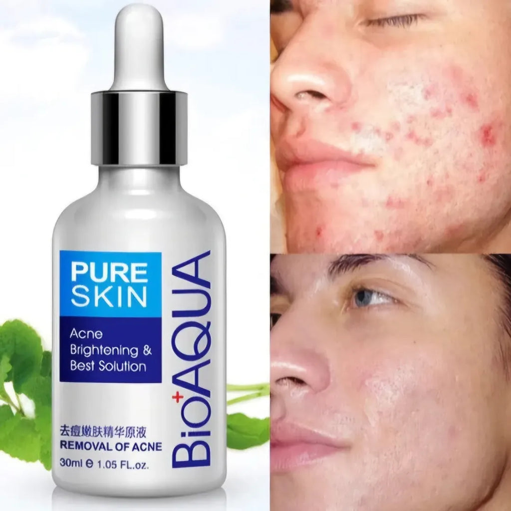 Serum Antiacne Bioaqua